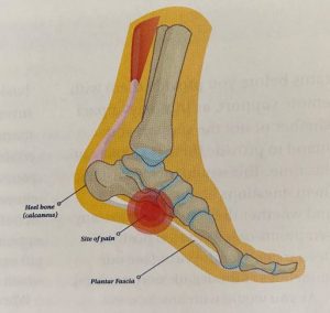 Plantar Fasciitis - a pain in the foot 1 Plantar Fasciitis - a pain in the foot